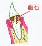 歯石5.jpg