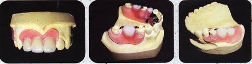 ノンクラスプ義歯１.jpg